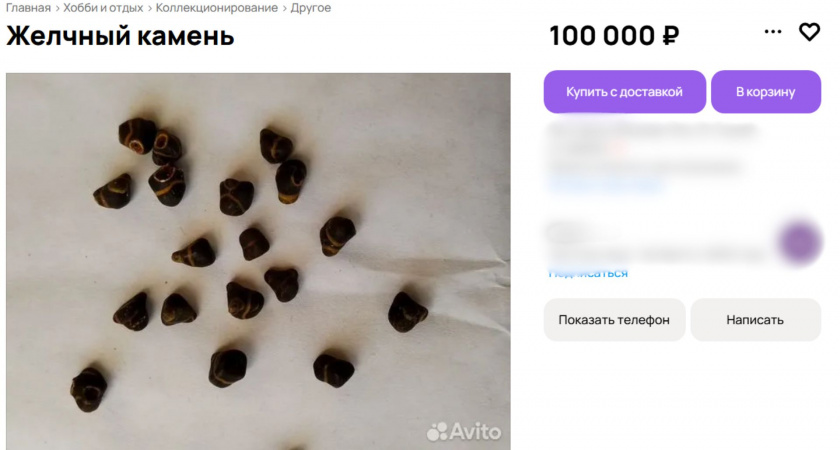 «Бизнес-план»: желчные камни для личной коллекции продают в Твери за 100 тысяч рублей