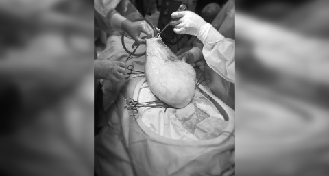 Гигантскую опухоль весом 9 литров удалили у пациентки тверские гинекологи